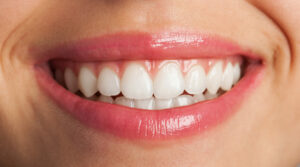 Blanqueamiento dental