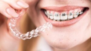 Brackets o alineadores transparentes