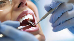 Limpieza dental profesional
